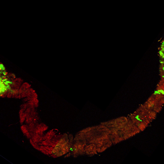 tumeurs dans le tube digestif d'une drosophile