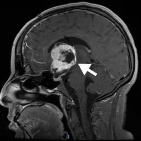 Un marqueur caractéristique d’un sous-type de tumeurs cérébrales